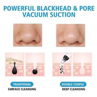 Three-color light-absorbing blackhead artifact