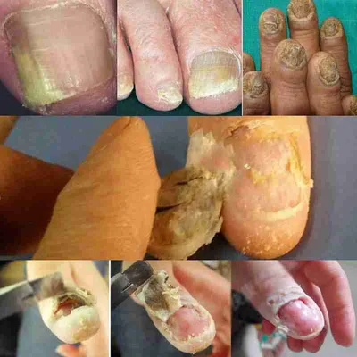 Fungal Nail Remove Nail Removal Cream Packet