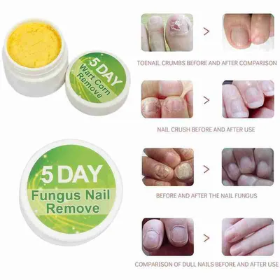 Fungal Nail Remove Nail Removal Cream Packet